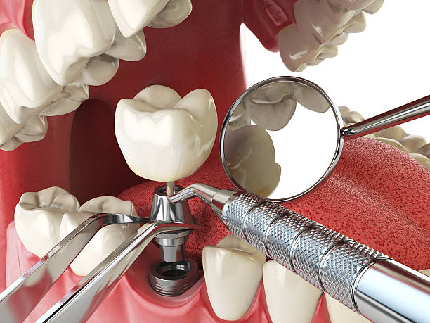 Best Emergency Denture Repair in Whitney Point, NY